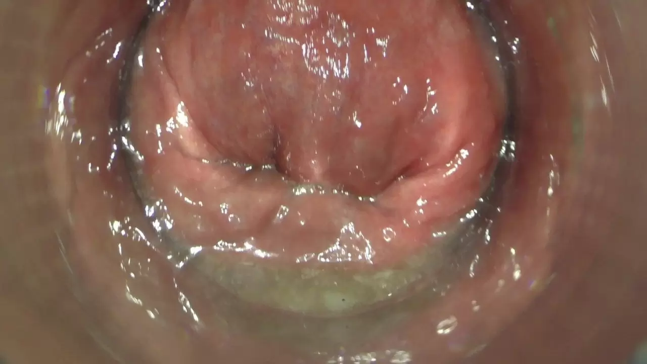 ANAL ENDOSCOPY